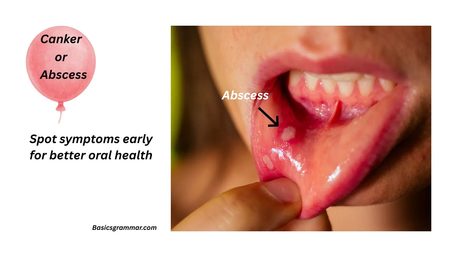 canker-or-abscess